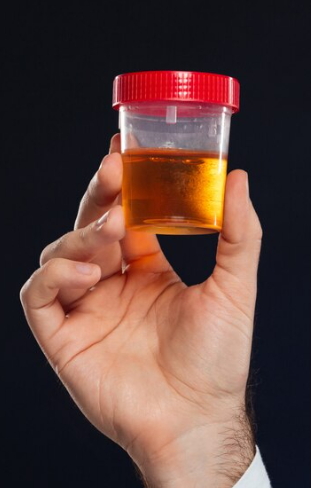 Blood in Urine Hematuria