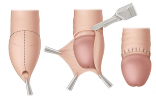 Circumcision