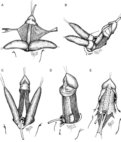 Epispadias