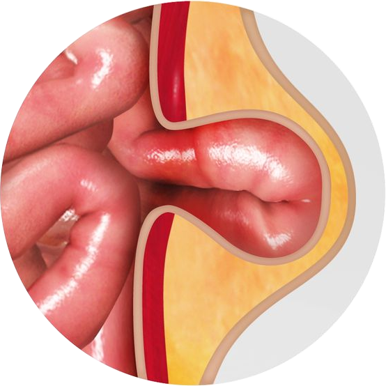 Hernia