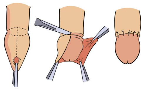 Phimosis