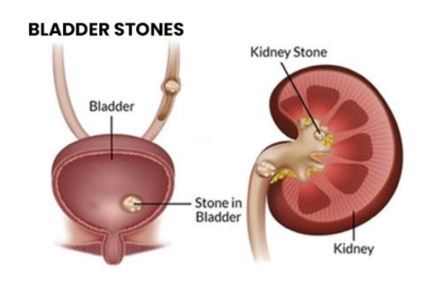 pediatric urologist in Hyderabad